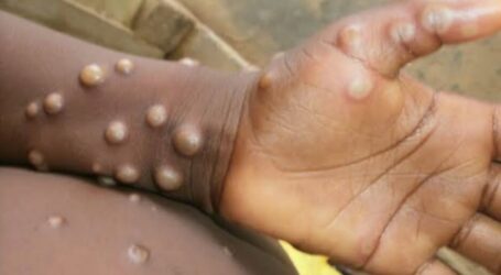 Ministry of Health: Monkeypox Has Not Detected in Indonesia