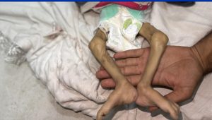 The dead body of 11-month-old baby Zeyneb Abu Halib, who died due to malnutrition, is seen at the Nasser Hospital in Khan Yunis, Gaza, on July 25, 2025. (Photo: Anadolu Agency)